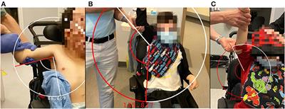 Case Report: Perspective of a Caregiver on Functional Outcomes Following Bilateral Lateral Pectoral Nerve Cryoneurotomy to Treat Spasticity in a Pediatric Patient With Cerebral Palsy